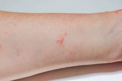 Alergická kožní vyrážka na vnitřním povrchu předloktí. Psoriáza, atopická dermatitida, ekzém. Kožní projevy. Kožní problémy — Stock obrázek