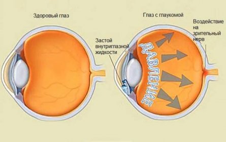 Typy glaukomu, symptomy, příčiny a léčba / Glaukom