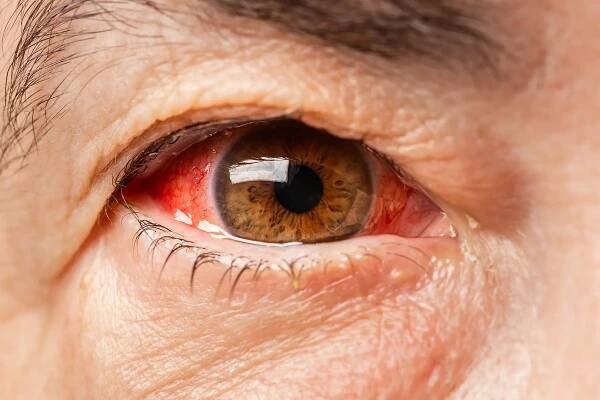 ¿Por qué tengo mucosias o moco en mis ojos?