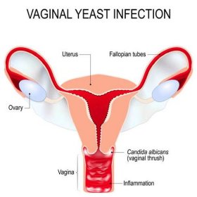vaginální kvasinková infekce - pochva ženská rozmnožovací soustava stock ilustrace