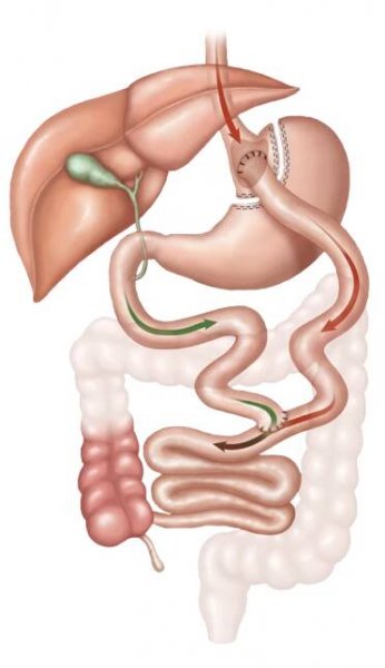 Gastric Bypass | St. Rita
