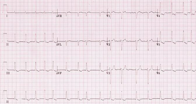 ECG digoxin pattern, downsloping sagging ST depression, short QT interval