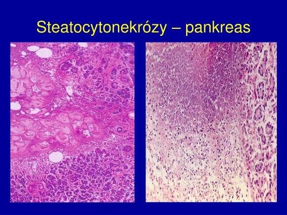 PPT - Nekrózy, gangrény PowerPoint Presentation, free download - ID:458546