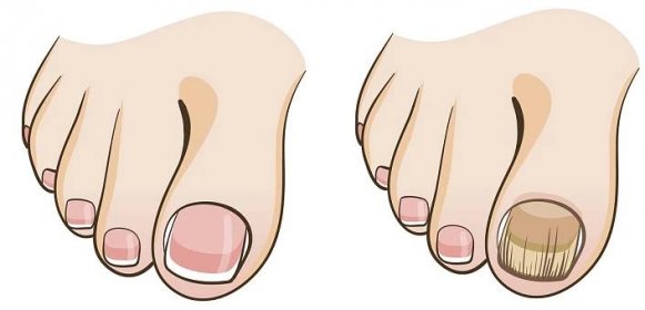 Plísně na prstech u nohou se lze zbavit účinnou domácí léčbou. Jednoduchý roztok se o vše postará za vás