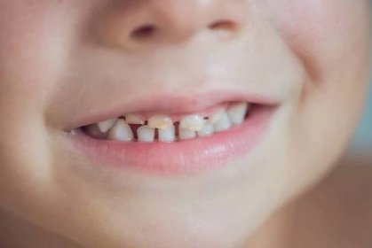 Mléčné zuby se kaz — Stock fotografie
