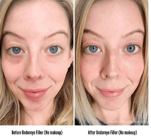 under eye filler cost