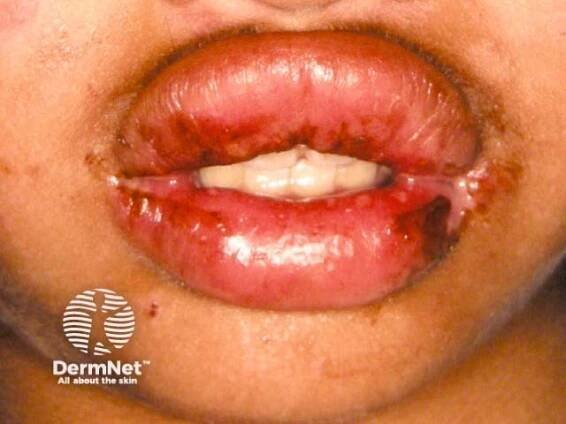 Herpes Simplex Images