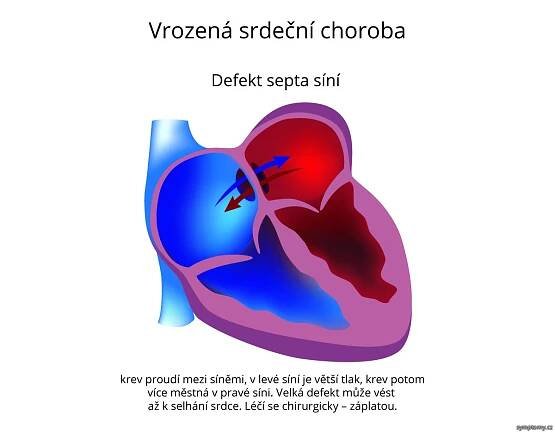 Defekt síňového septa (ASD) - příznaky a léčba
