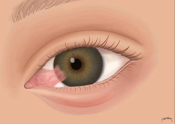 Pterygium