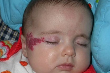 Léčba hemangiomů u dětí.Hemangiomy na hlavě, tváři, zádech, játra. Laserové odstranění hemangiomů