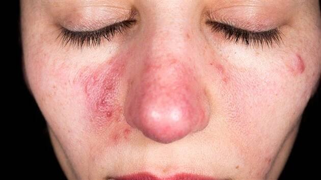 Růžovka (rosacea)