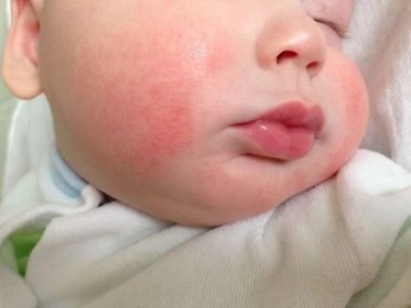 Teplota a vyr�ážka u dítěte: po horečce po celém těle, v krku a ústech