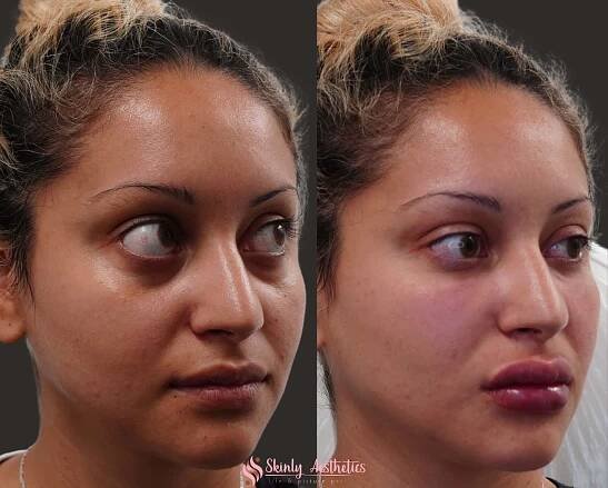 Liquid Facelift at a 45-degree angle clearly showing lifted cheeks, improved jawline definition, and softened nasolabial folds