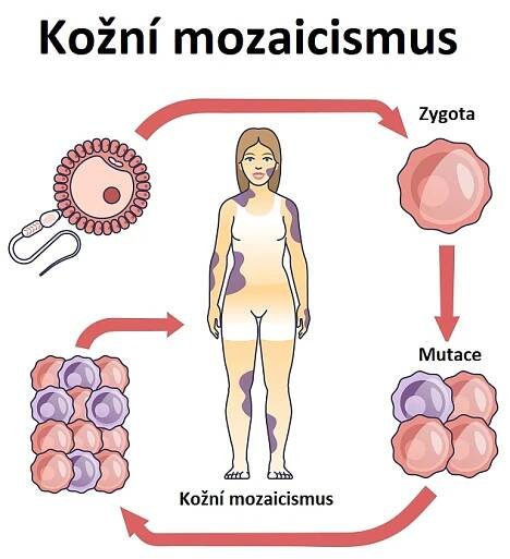 Kožní mozaicismus - ilustrace