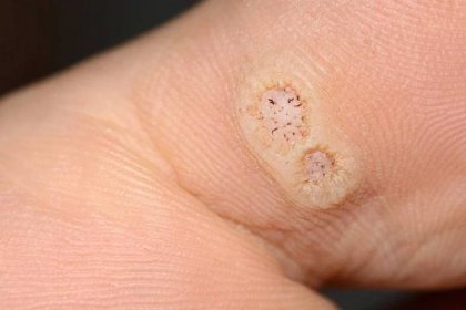 Detailní záběr na dvě plantární bradavice na palci způsobené lidským papilomavirem, nebo Hpv — Stock obrázek