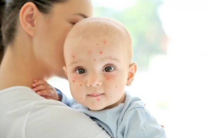 jak plané neštovice začínají u dětí první příznaky