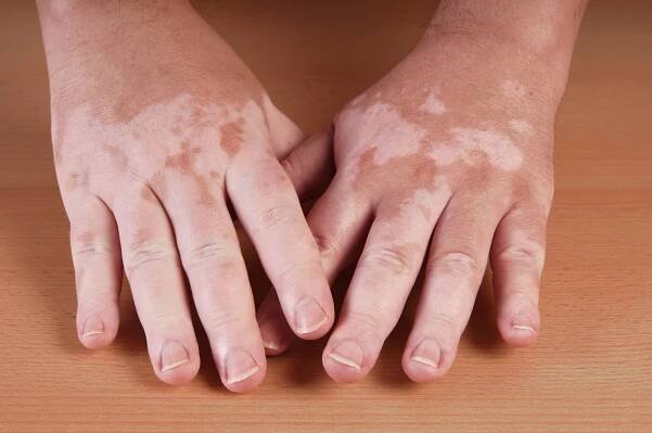 Vitiligo – nedostatek pigmentace v kůži a jak ho řešit