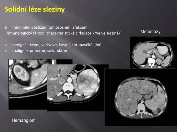 PPT - Benigní ložiskové léze jater PowerPoint Presentation, free download - ID:4010293