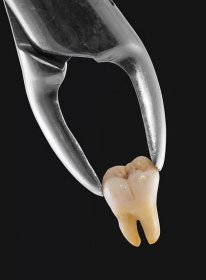 Extrakce zubů — Stock obrázek