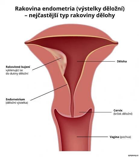 Rakovina endometria (výstelky děložní) - nejčastější typ rakoviny dělohy