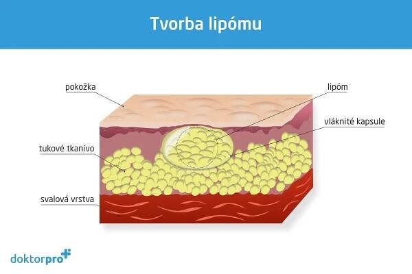 Lipóm – čo je to a ako sa dá liečiť?