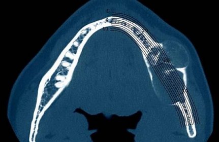 Nádor v dutině ústní, který je v dásni pod zubem na snímku z CT.