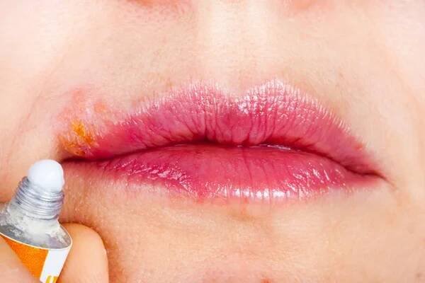 Herpes na rtu makrofotografie. Žena maže retní opar mast — Stock obrázek