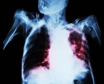 Plicní tuberkulóza s akutní respirační selhání (Film rentgenový snímek ze starých pacientů ukazují alveolární a intersticiální infiltrace obou plic s endotracheální trubice) způsobené bakterií mycobacterium tuberkulóza — Stock fotografie