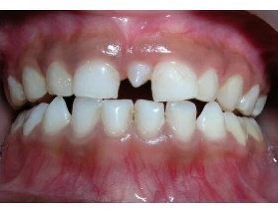 Extra Tooth Erupting In The Nose!