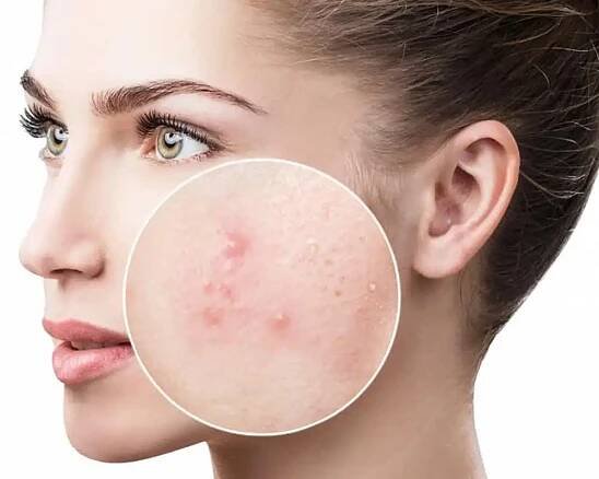 Anti-Blemish Acne Treatment in Brno