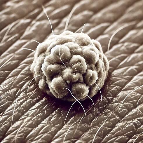 Effective Treatments for Condyloma Acuminatum: Anogenital Warts Management