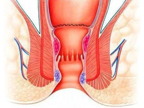 best laser piles treatment doctors in indore- Indore Laparoscopy Center