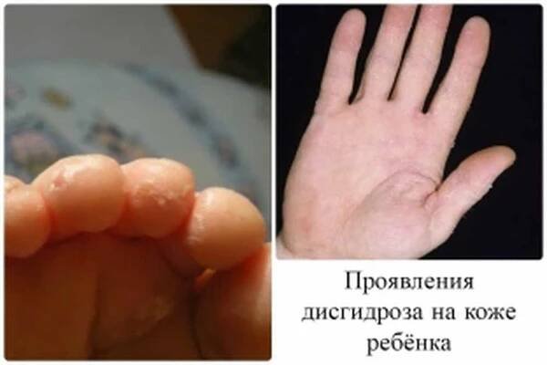 Co může způsobit dyshidrosu kůže? / Články | Užitečné informace a tipy na péči o sebe. Zdraví, výživa a další.