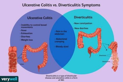 Ulcerative Colitis vs. Diverticulitis Symptoms
