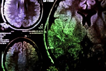 Barevné x-ray skenování mozku — Stock obrázek