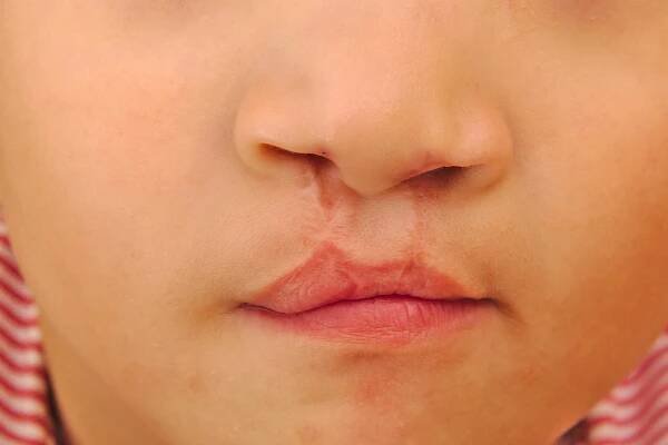 Cleft Lip and Palate: MedlinePlus