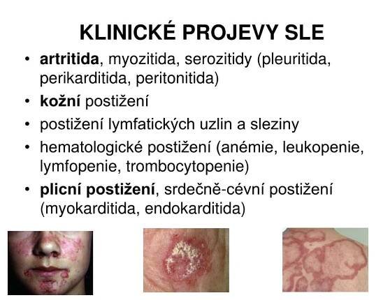 PPT - Imunodeficience a autoimunitní onemocnění PowerPoint Presentation - ID:3960798