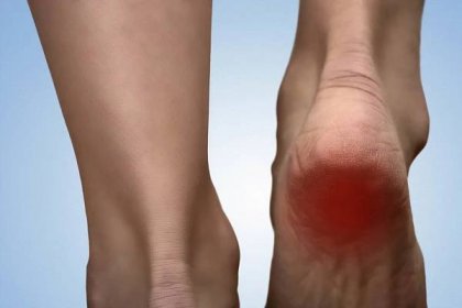 Stáhnout - Bolestivé paty s červenou skvrnou na ženské nohy. Artritida. Jediný výběžek koncept. Bolesti paty v žen. Bolest concep — Stock obrázek