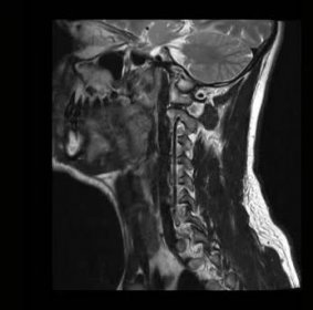 Vypočítanou lékařské tomografie magnetickou rezonancí muže s osteochondróza krční páteře — Video © RabbitCorp #229701374