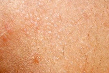 Alergická vyrážka dermatitida kůže textura
