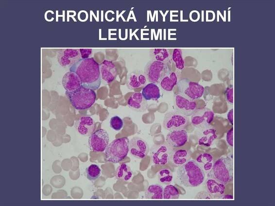 CHRONICKÁ MYELOIDNÍ LEUKÉMIE