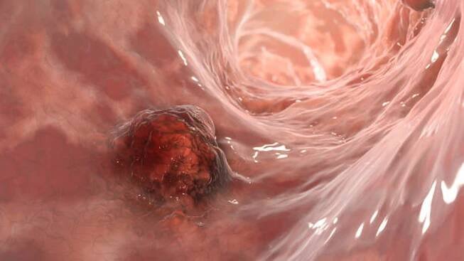 Kolorektální karcinom, střevní karcinom, střevní neoplazie, 3D ilustrace zhoubného nádoru ve střevě — Stock obrázek