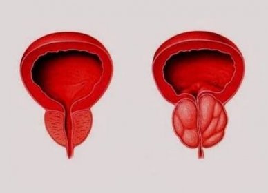 Zdravá prostata (vlevo) a zanícená v důsledku prostatitidy (vpravo)