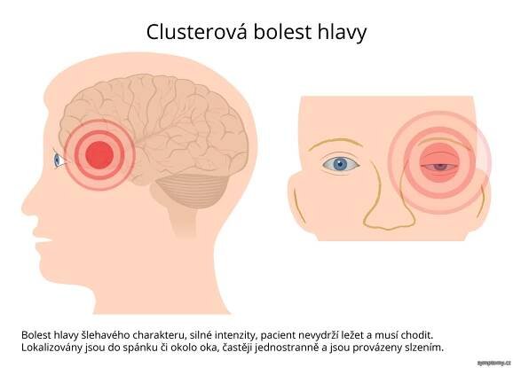 Klastrová bolest hlavy - příznaky a léčba