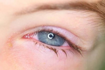 Jak léčit zánět očí?