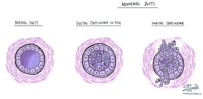 Duktální karcinom in situ (DCIS) prsu – MyPathologyReport
