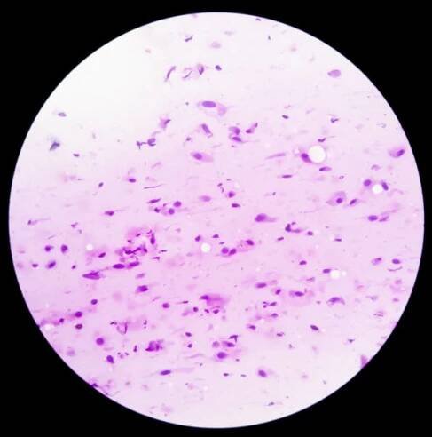 mikrosnímek ukazující neurofibrom. neurofibromatóza je genetická porucha, genové mutace. - neurofibromatóza - stock snímky, obrázky a fotky