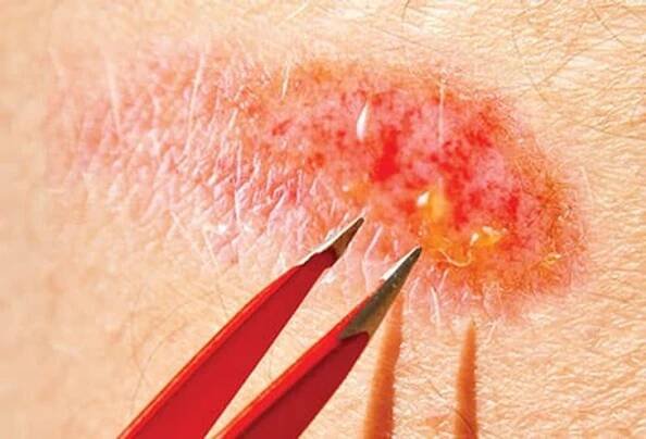 Wound Care Step 4: Remove Debris