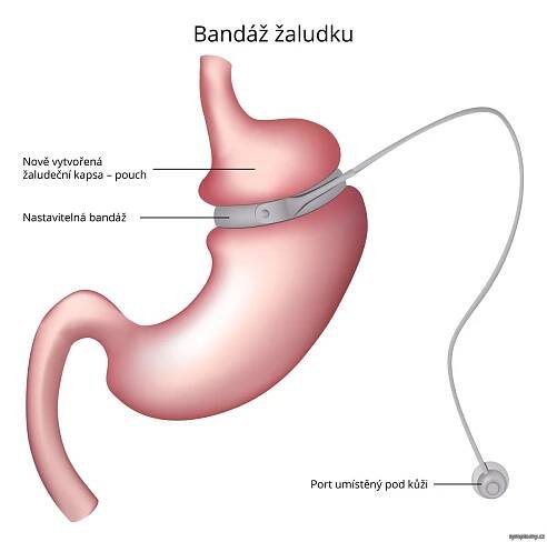 Bandáž žaludku