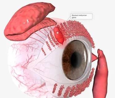 Povrchové chalazie tvoří, když žlázy podél okraje víčka se infikují a zablokují. 3D vykreslování — Stock obrázek